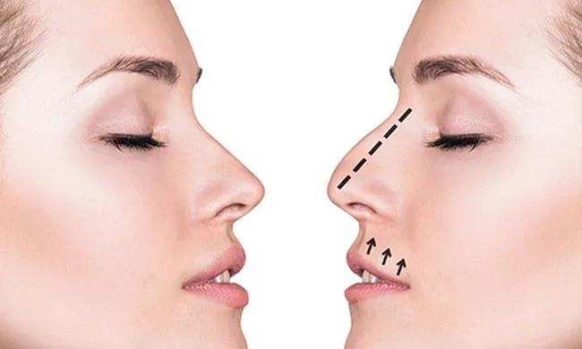 Як обрати клініку для корекції великого носа з природним результатом?