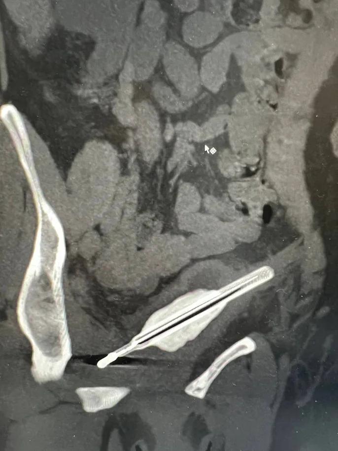 Львівські медики видалили з тіла жінки ртутний термометр, з яким вона прожила 8 років